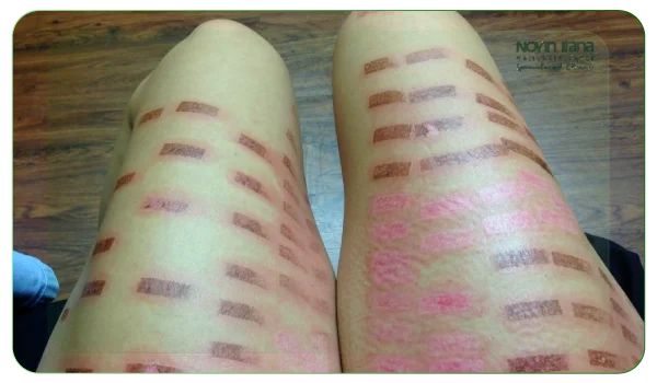 معایب و عوارض احتمالی لیزر مو