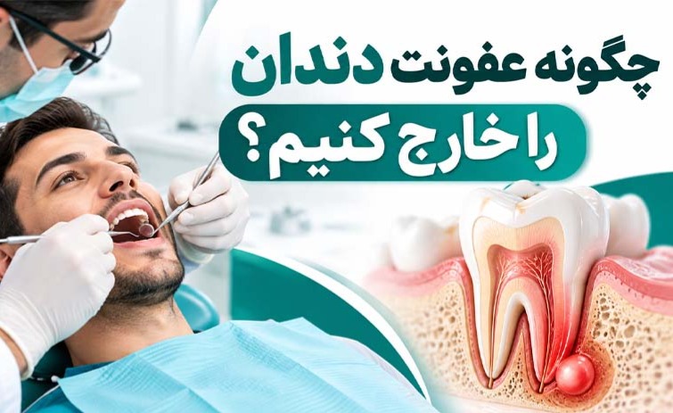 چگونه عفونت دندان را خارج کنیم؟ 1 93811f76 7695 4000 a230 8c949a4a2ff8
