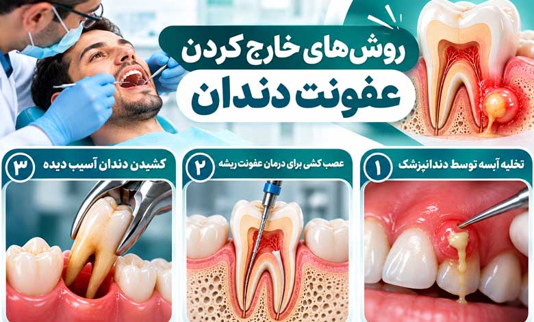 چگونه عفونت دندان را خارج کنیم؟ 2 روش های خارج کردن عفونت دندان